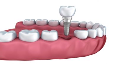 Photo of Why get dental crowns?