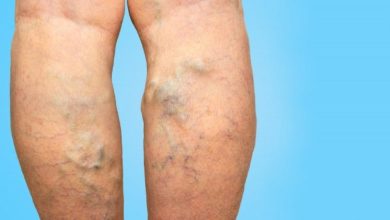 Photo of Symptoms, Risk Factors, and Prevention of Spider Veins and Varicose Veins