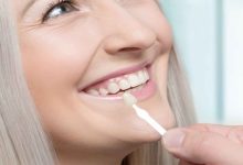 Photo of 7 Advantages of Using Dental Veneers